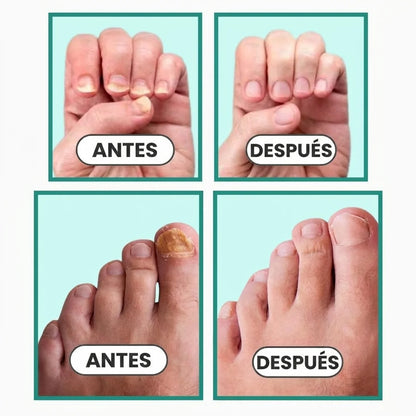 Dispositivo Nivora para Hongos en Uñas
